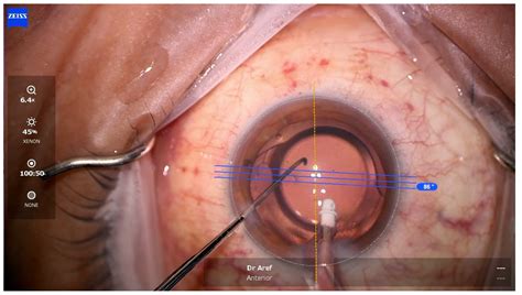 Vision Free Full Text Astigmatism Management In Modern Cataract Surgery