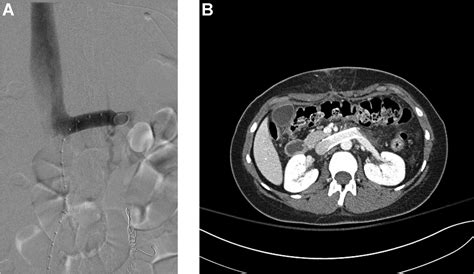 Systematic Review Of Endovascular Versus Laparoscopic Extravascular