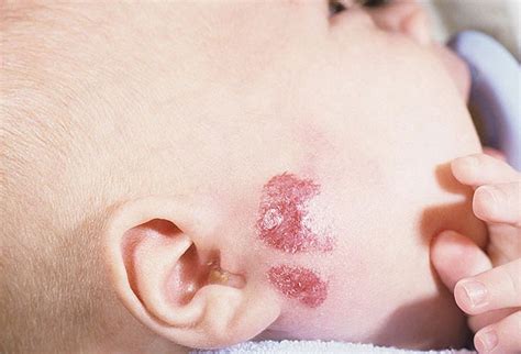 Hemangioma Newborn Pictures 54 Photos And Images