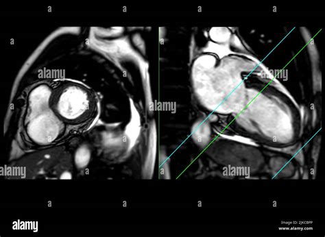 Mri Heart Or Cardiac Mri Magnetic Resonance Imaging Of Heart In Short Axis And Vertical Long