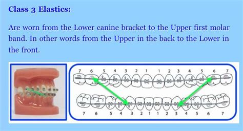 Class 3 Elastics Dental Braces Orthodontics Orthodontics Braces