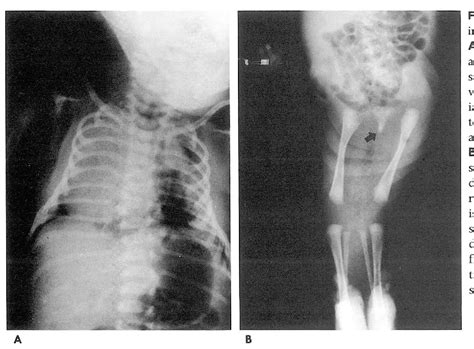 Figure 1 From Caudal Regression Syndrome A Case Report Semantic Scholar