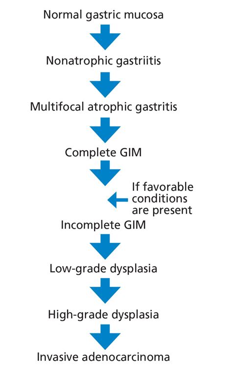 Gastric Intestinal Metaplasia And Gastric Cancer Prevention Watchful Waiting Cleveland Clinic