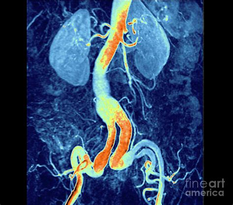 Aneurysm Of Iliac And Renal Arteries Photograph By Zephyr Science Photo