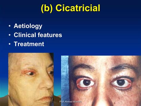 Eyelid Disorders Ppt