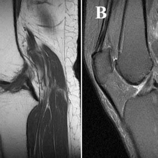 Preoperative Mri Showed That The Synovial Membrane Of The Knee Joint