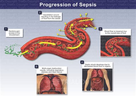 Progression Of Sepsis Medical Illustration Trialexhibits Inc Hot Sex