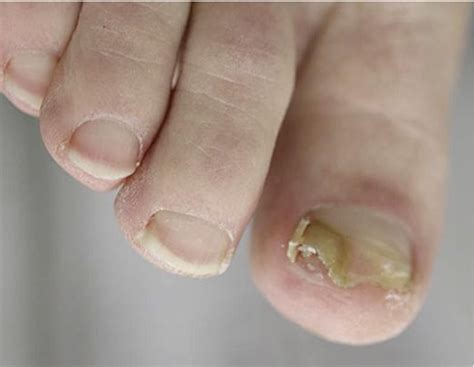 Figure 2 From Green Nail Syndrome Pseudomonas Aeruginosa Nail