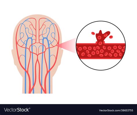 Brain Stroke Hemorrhagic Royalty Free Vector Image