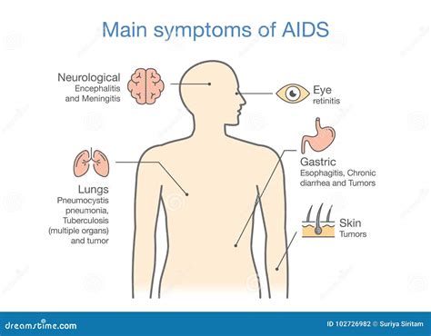 Diagram of Main Symptoms of AIDS. Stock Vector - Illustration of ...