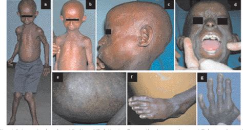 Figure 1 From Le Syndrome De Hutchinson Gilford PROGERIA Analyse