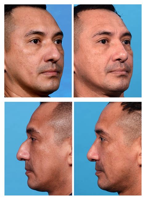 Male Rhinoplasty Before and After Photos