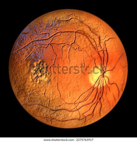 Best Disease Best Vitelliform Macular Dystrophy Stock Illustration ...