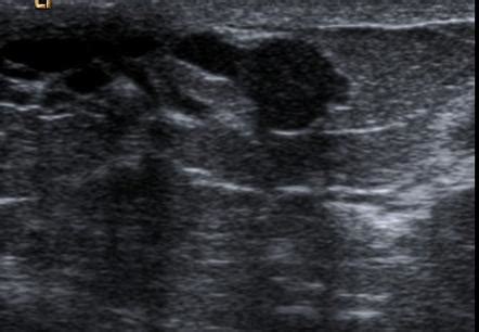 Intraductal Papilloma Of Breast Radiology Reference Article