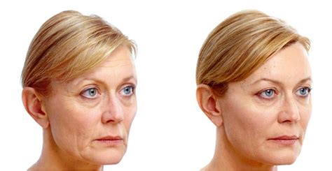 Lipofilling Visage Tunisie Chirurgie Esthetique Du Visage Par Injection