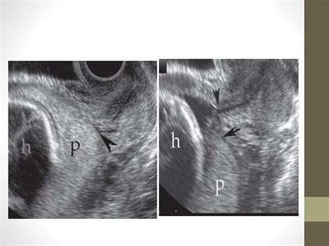 Antepartum Haemorrhage I