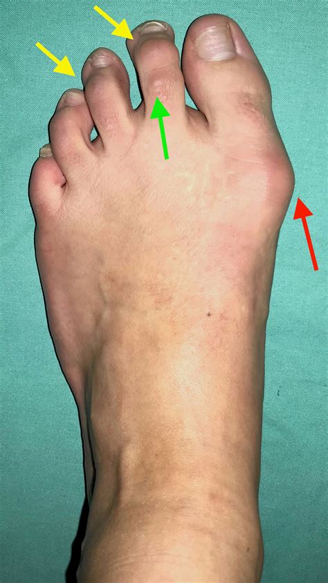 Hallux Valgus Dr Michael Vitek Wien