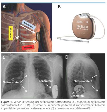 Il Defibrillatore Sottocutaneo Nella Pratica Clinica Giornale