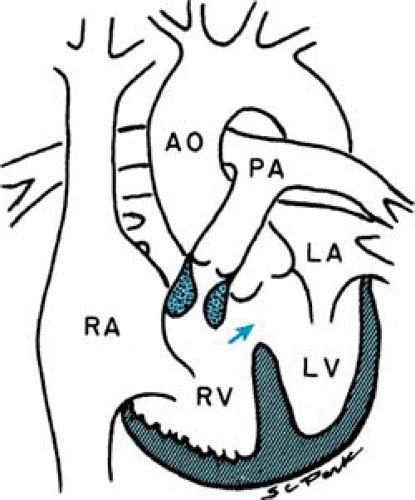 Tetralogy Of Fallot Musculoskeletal Key