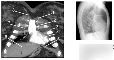 Diagram Of Coronal Contrast Enhanced Chest W Mediastinal Windows 1