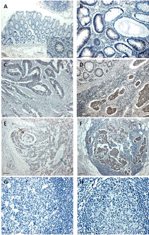 Immunohistochemical Assessment Of Hsp60 Helps To Diagnose Crc A Hsp60