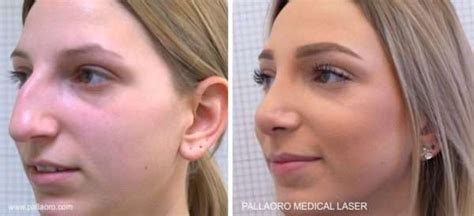 Rinoplastica Foto Chirurgia Estetica Pallaoro Medical Laser