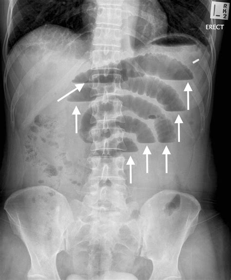 Labeled Abdominal X Ray