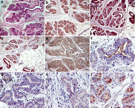 Immunohistochemical Characterization Of Buffalo Mammary Carcinoma