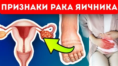 Важно каждой женщине знать эти симптомы рака яичников! - YouTube
