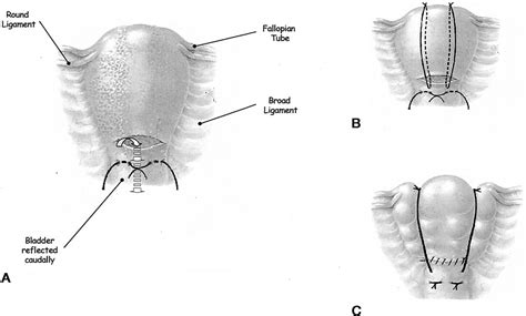 Uterine Compression Sutures Surgical Management Of Postpartum