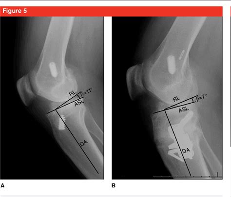 Figure 1 From The Role Of High Tibial Osteotomy In The Varus Knee