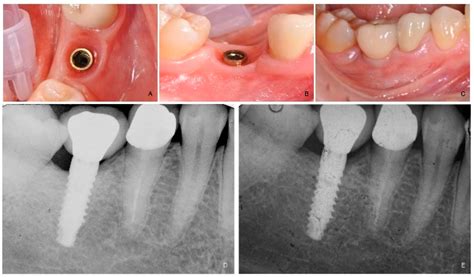 Dentistry Journal Free Full Text New Generation Of Fixtureabutment