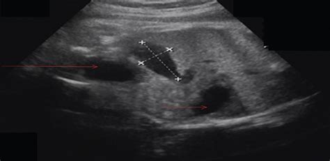 Prenatal Diagnosis And Management Of Fetal Intra Abdominal U