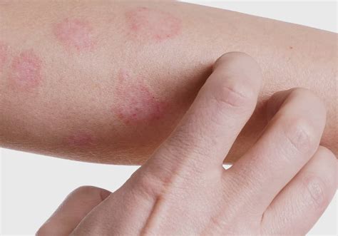 Dermatite O que é sintomas tipos da doença e como tratar