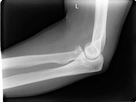 Essex Lopresti Fracture Dislocation Radiology Case Radiopaedia Org