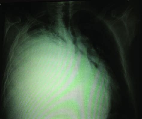 Chest Radiograph Postero Anterior View Shows The Presence Of A