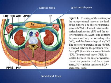 Retroperitoneal Masses