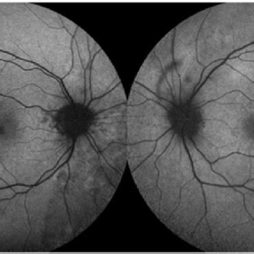 Fundus Autofluorescence Faf Images Showing Peripapillary