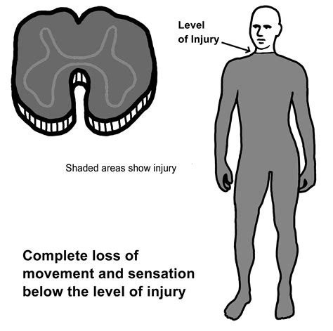 Anterior Cord Syndrome Symptoms