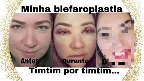 Toda Verdade Sobre A Minha Blefaroplastia Antes Durante E Depois