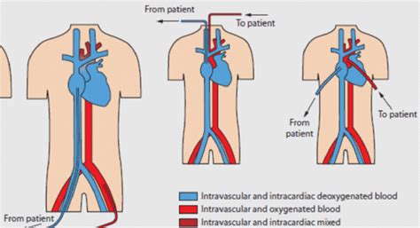 Va Ecmo Showing Femoral Cervical And Central Cannulation The Blood