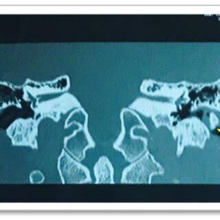 Excised left ear canal osteoma. | Download Scientific Diagram