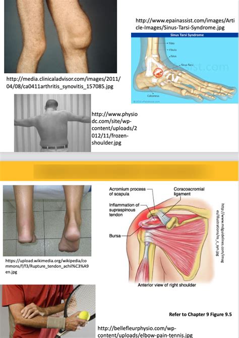 Synovitis Capsulitis Chronic Msk Diagram Quizlet