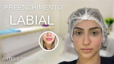 Preenchimento Labial Antes E Depois 1 Ml De Ácido Hialurônico Youtube