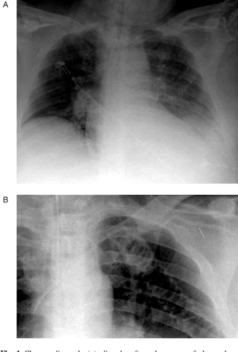 Figure 1 From Early Transection Of A Central Venous Catheter In A