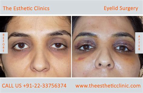 Best Eyelid Surgery In Mumbai India Cost Price