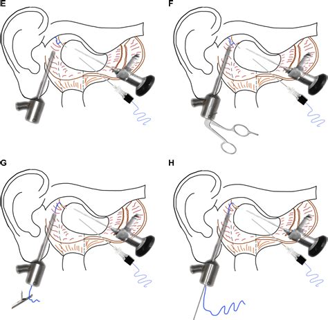 Arthroscopic Disc Suturing And Repositioning Technique For Treating