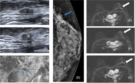 Value Of Multimodal Imaging In The Diagnosis Of Breast Sclerosing