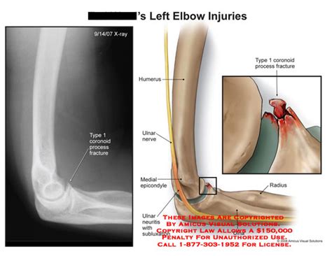 Amicus Illustration Of Amicuis Injury Elbow Coronoid Fracture Ulnar Neuritis Nerve Bone