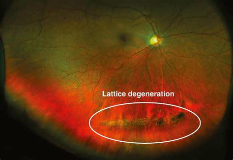 Lattice Degeneration Clinical Tree